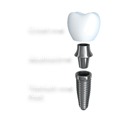 These are the 3 parts of a dental implant the crown, abutment, and post